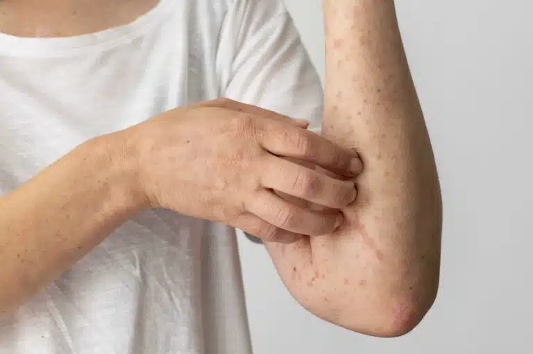 can you be allergic to weed if you are scratching your arm covered in red bumps